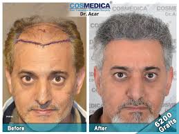 If you are a past patient of hhh natural hair transplant center please click the 'write review' button to provide your review for others to read. Usb19ksyf16sxm