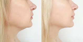 Kybella