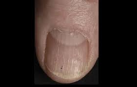 Image result for Pitting nails feet