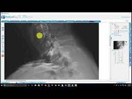 Последние твиты от tony ferguson (@tonyfergusonxt). Ap Modified Ferguson View Short Leg Analysis Cbp Technique Postureco Inc Posturescreen Leanscreen Remotescreen Squatscreen Postureray