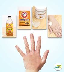 Soaking in a baking soda bath may help to neutralize the acid in your urine, remove germs, and aid in healing. How To Get Rid Of Fungal Infection Kill The Fungus Naturally Fab How