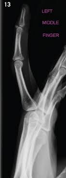 My daughter has three vollar avulsion fractures at the pip joint in her pinky, ring and middle fingers. Aspetar Sports Medicine Journal Acute Finger Injuries In Handball