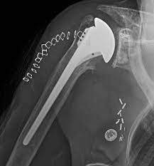Pin On Shoulder Arthritis