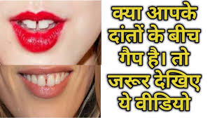 दांत कैपिंग प्रक्रिया के लिए इमेज परिणाम