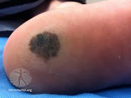 Image result for Acral lentiginous melanoma nail