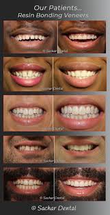 Front tooth chips are typically repaired with a procedure called bonding that uses composite resin to fill the gap. Cosmetic Dentist Nyc Veneers Nyc Sachar Dental Nyc