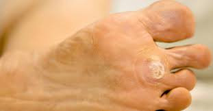 What is the mechanism for this maddening resilience? Plantar Warts Symptoms Causes And Treatment