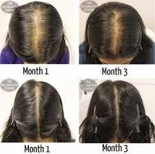 Spironolactone helps with acne and hair loss. 25 Hair Ideas Hair Hair Transplant Hair Loss