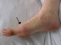 Image result for gout symptoms knee