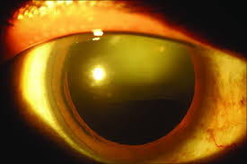 Image result for Coloboma