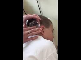 Shunt Valve Setting Change Youtube