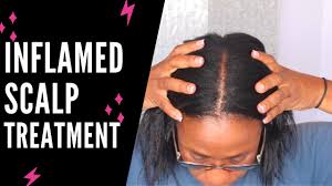 There are a number of disorders that can be contributing to scalp inflammation and if left untreated can cause hair loss. Betnovate Scalp Application For Inflamed Scalp Youtube