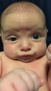 Baby Might Have Horner S Syndrome August 2016 Babycenter Canada