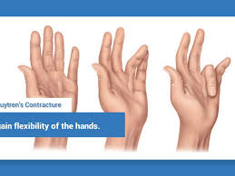 Dupuytrens Contracture Phoenix Doctors Dupuytren S Contracture Dupuytren S Contracture Surgery Hand Surgery