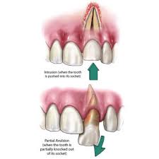 Image result for Tooth Avulsion