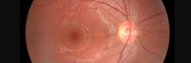 Image result for Edema Exam