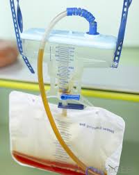 How to get rid of blood clots in bladder. What Is A 3 Way Catheter With Pictures
