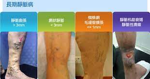 靜脈曲張 central vascular clinic disease vascular