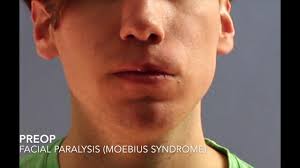 This is an example of #facialreanimation to restore smiling in a patient  with #facialparalysis. In this patient, I use my personal technique of  lengthening temporalis myoplasty. This procedure is done ...