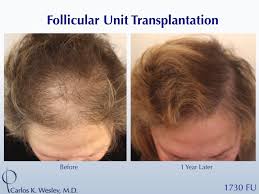 نتيجة بحث الصور عن ‪hair transplant surgery‬‏