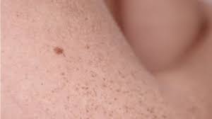 Subscribe to our free newsletters to receive latest health news and alerts to your email inbox. Arm Mole Count Predicts Skin Cancer Risk Keep Fit And Healthy With Carol Martin