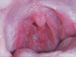 Serious allergic reactions can also produce similar symptoms. Strange Lumps In Back Of Throat Health Anxiety At An All Time High Other Conditions And General Health Forums Patient