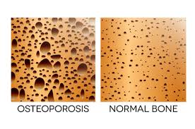 Bone Density Chart Understand Your Bone Density Scores