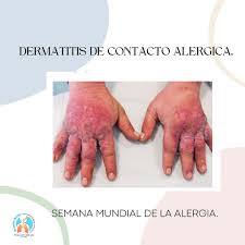Image result for dermatitis contacta toxica