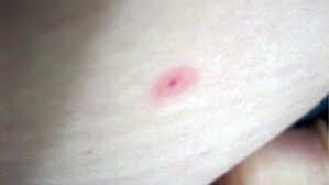 Image result for flea bites