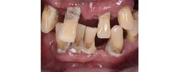 Image result for Dentition