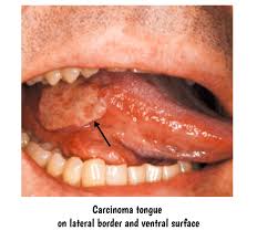 Image result for cancer of tongue