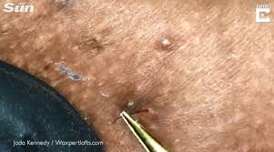 These are few of the signs and symptoms of an ingrown hair the main cause of ingrown hair is faulty hair removal practices. Grim Video Shows Pus Stream Out Of Woman S Bikini Line As Ingrown Hairs Are Pulled Out