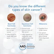 Melanoma is a deadly form of skin cancer. Aad On Twitter Skin Cancer Is The Most Common Cancer In The Us Learn More About The Different Types And The Signs To Look For Https T Co Id8olv8ocg Skincancerawarenessmonth Https T Co Yjrcyjkz05 Twitter
