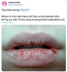 Liputan6.com, jakarta mengalami kulit kering di sekitar bibir memang bikin enggak nyaman. Gigit Jilat Punca Bibir Jadi Kering Ini Tip Produk Atasinya Elak Menggelupas Teruk Rapi