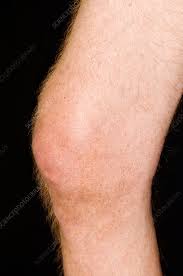 Image result for gout symptoms knee