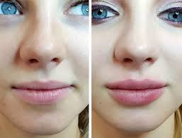 Lip Fillers Guide Type Of Lip Injections Costs And Side Effects Lipsfillers Lip Fillers Guide Type Of Lip Inj Lip Fillers Lip Injections Cost Lip Implants