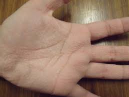 Aquagenic Wrinkling Of The Palms Dermnet Nz