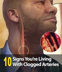 Clogged arteries are a dangerous health problem. Catching it early can save  your life. Here are 10 signs your arteries are blocked.