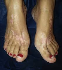 Image result for dermatitis contacta