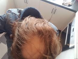 So do you have a. Freyja Katra Valentine On Twitter Cw Hair Loss Hrt Progress I Can T Believe How Much My Hair Has Healed In A Year I Want To Emphasize I Was Told Not To