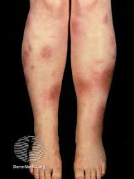 Image result for erythema nodosum