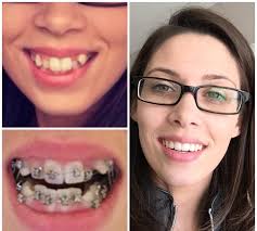 The smaller ones aren't too bad, they wear down pretty quickly to a shape that is easier to eat with. Swords Orthodontics Blog My Brace Journey
