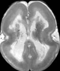 It is caused by defective neuronal migration during the 12th to. Pediatric Radiology