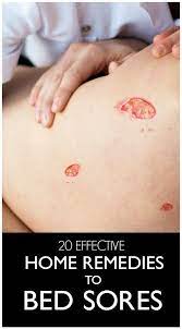 Home Remedies Bed Sores Soreness Skin Ulcer