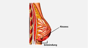 Brustentzundung Weibliche Mastitis