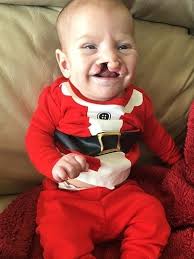 Após sofrer bullying na web, bebê recebe doação para tratamento de fissura 