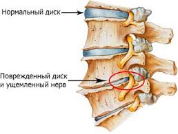 Osteohondroz Poyasnichnogo Otdela Pozvonochnika