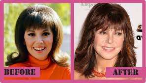 Is this due to genetics or plastic surgery? Marlo Thomas Plastic Surgery Did She Have It