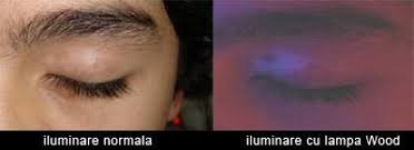 Tratamente La Zi Pentru Vitiligo Vitiligo Ro