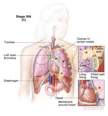 The organs that may cause pain in that region are the heart, left lung, stomach, adrenal gland, left kidney, left ureter, spleen, pancreas, left the fallopian tube, and left the ovary. Non Small Cell Lung Cancer Treatment Mhealth Org